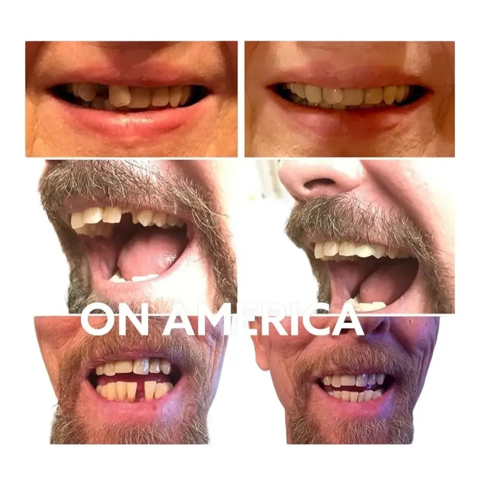 Kit Diente Provisorio Para Reemplazar Un Diente Easy Tooth